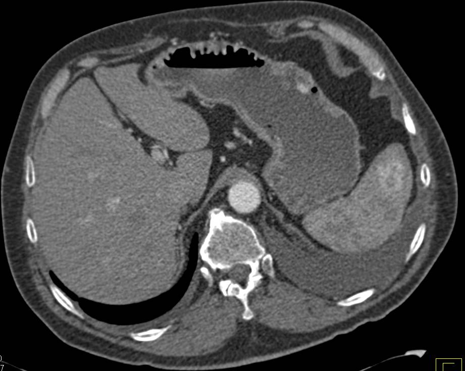 Renal Cell Carcinoma Metastatic to Pancreas, Bone and Stomach - CTisus CT Scan