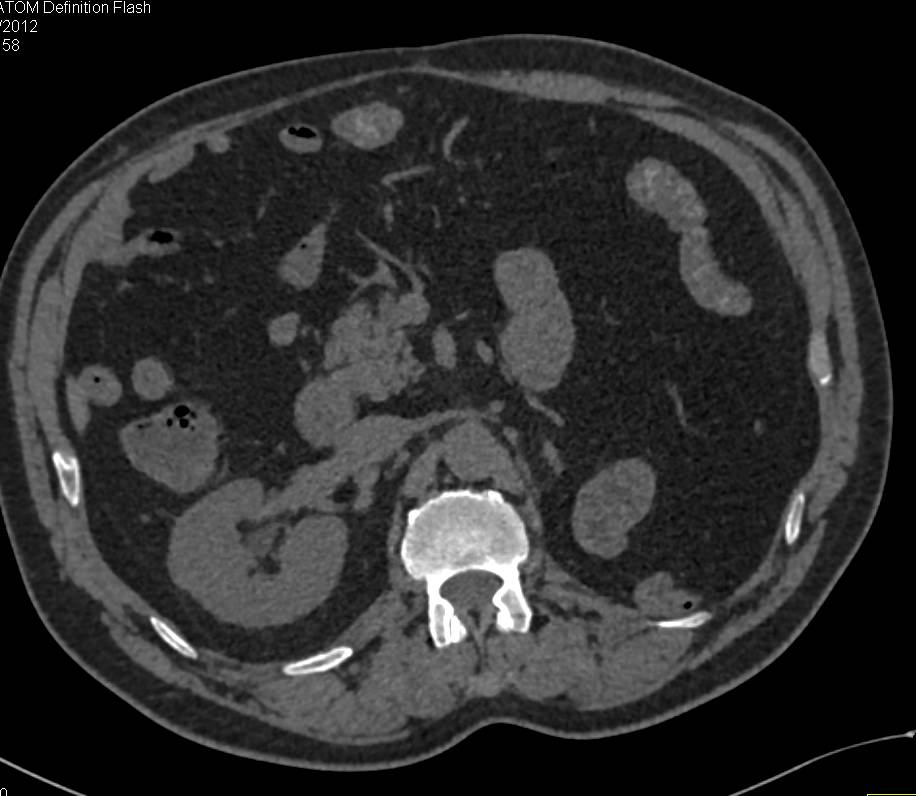 Left Nephrectomy Without Recurrence - CTisus CT Scan