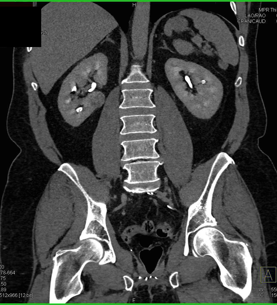 Incidental Right Renal Cell Carcinoma in Patient with History of Transitional Cell Cancer (TCC) Bladder - CTisus CT Scan