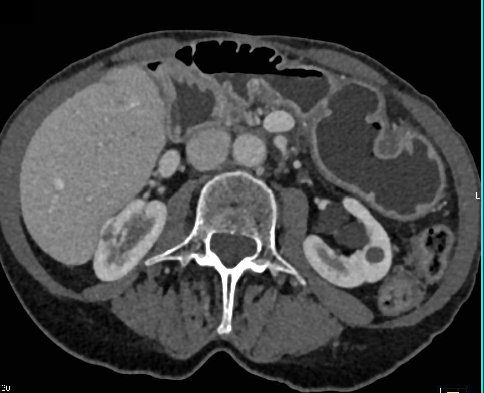 Incidental 8 mm Right Renal Cell Carcinoma - CTisus CT Scan