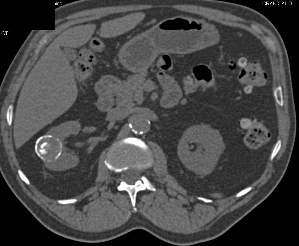 Bosniak 2F Cyst Right Kidney - CTisus CT Scan