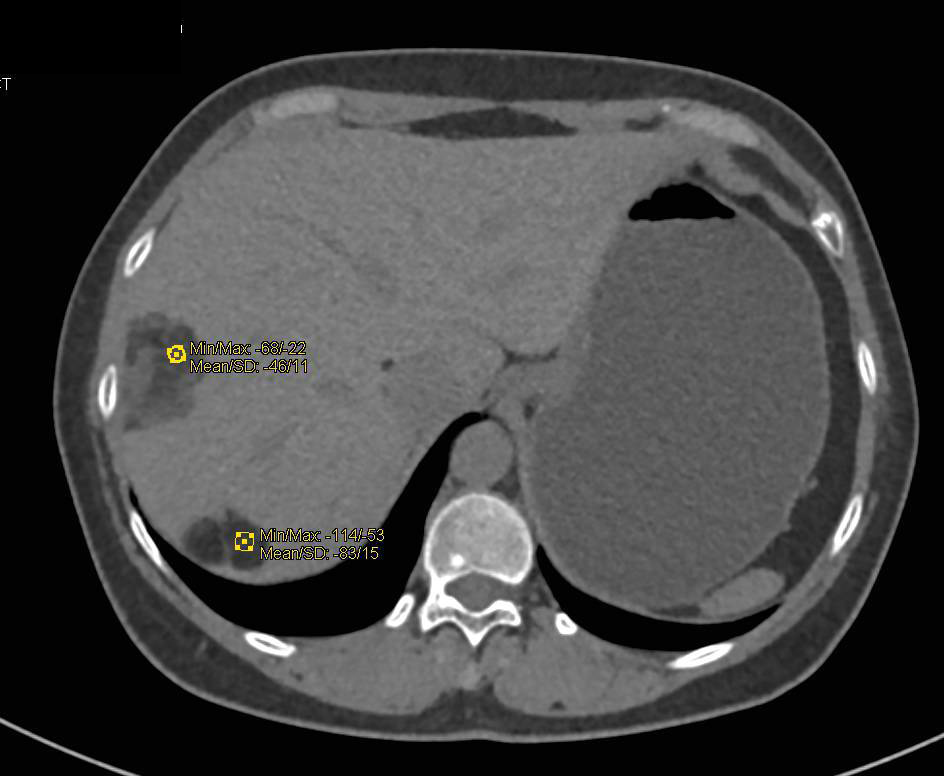 Incredible Case of Hepatic and Renal Angiomyolipomas - CTisus CT Scan