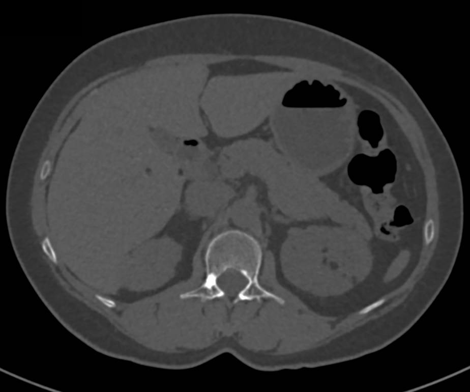 Renal Angiomyolipoma with Extensive Vascularity - CTisus CT Scan