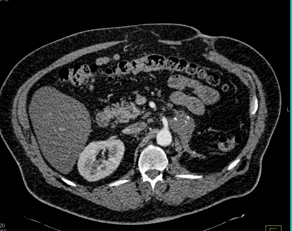 Recurrent Renal Cell Carcinoma Involves the Tail of the Pancreas - CTisus CT Scan