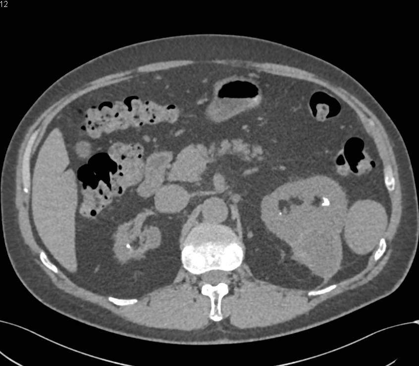 Subcapsular Hematoma Left Kidney due to Prior Biopsy - CTisus CT Scan