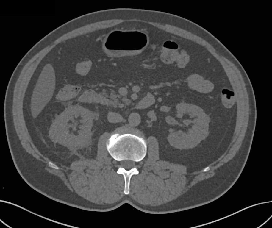 Blood Clot in Right Ureter due to Hematuria From Stone Disease - CTisus CT Scan