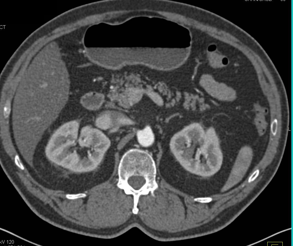 3D Visualization of the Renal Veins - CTisus CT Scan