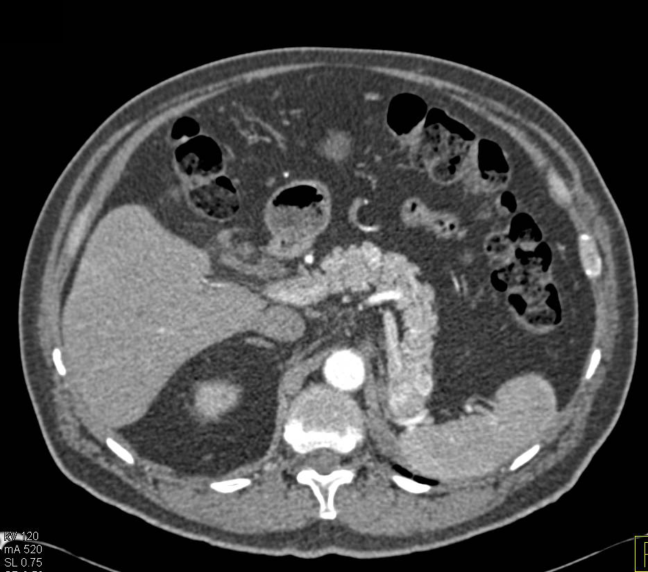 Recurrent Renal Cell Carcinoma Metastatic to the Pancreas - CTisus CT Scan