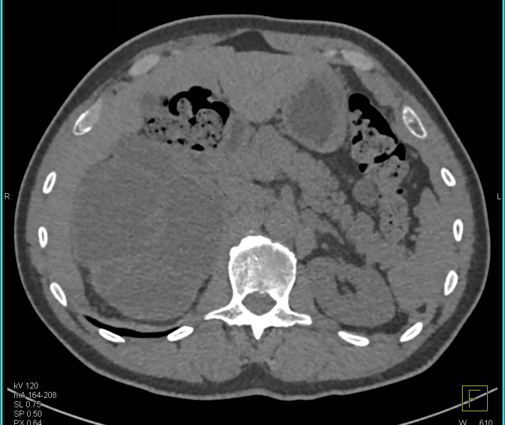 Mixed Epithelial Stromal Tumor (MEST) of the Kidney - CTisus CT Scan