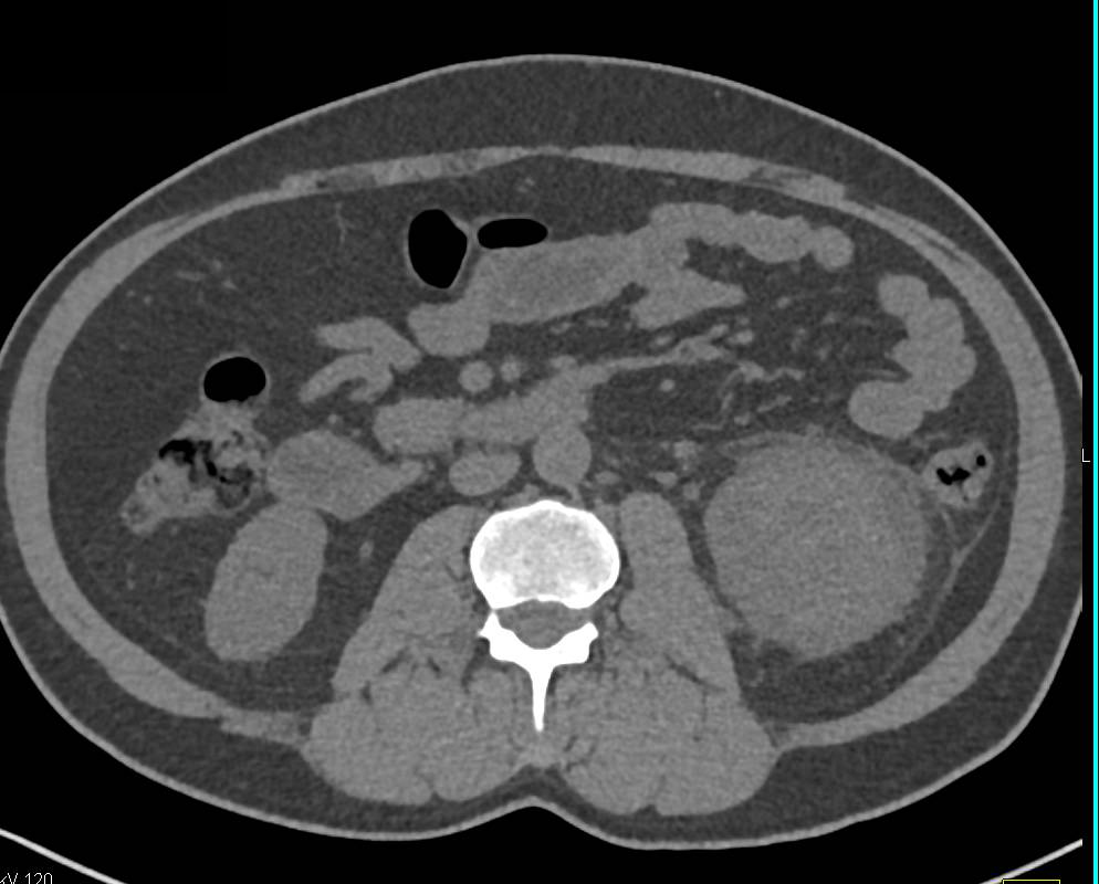 Acute Pyelonephritis with Abscess - CTisus CT Scan