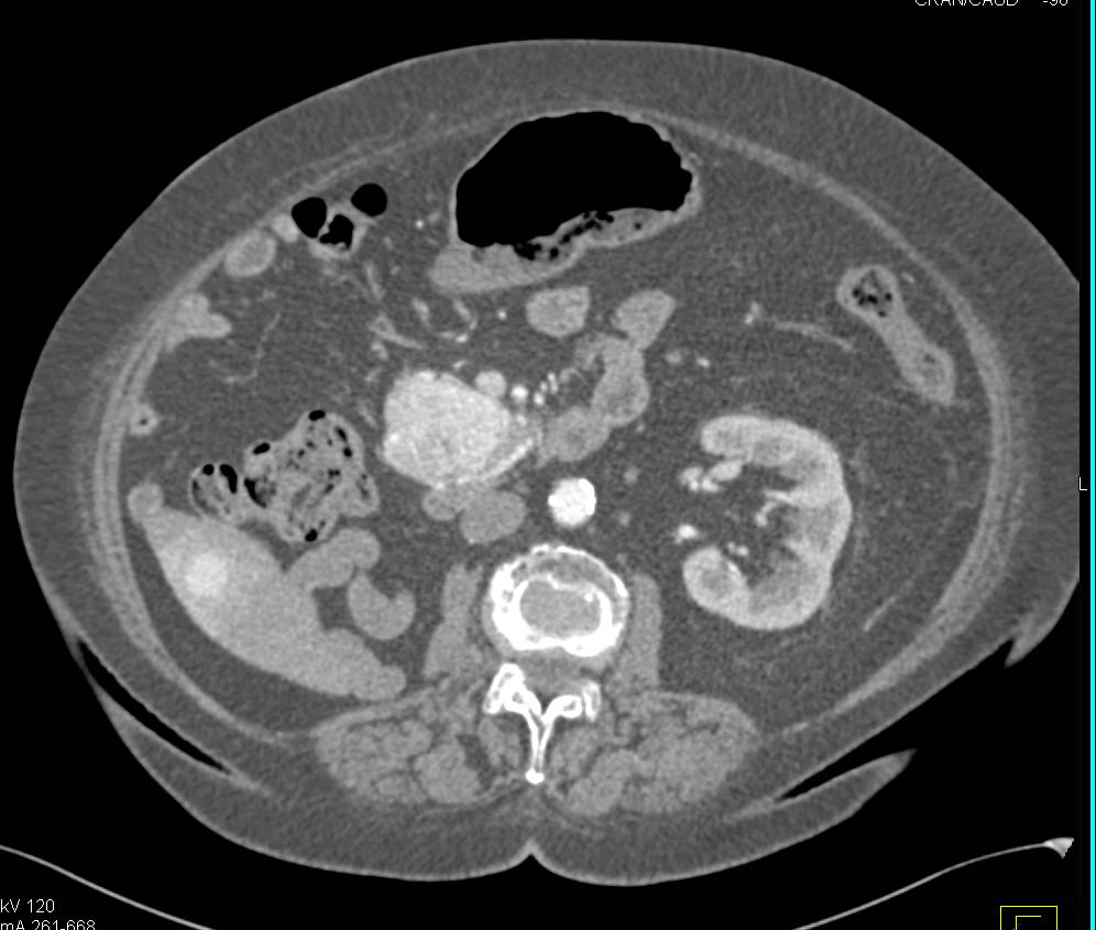 Recurrent Clear Cell Renal Cell Carcinoma with Metastases to Liver and Pancreas - CTisus CT Scan