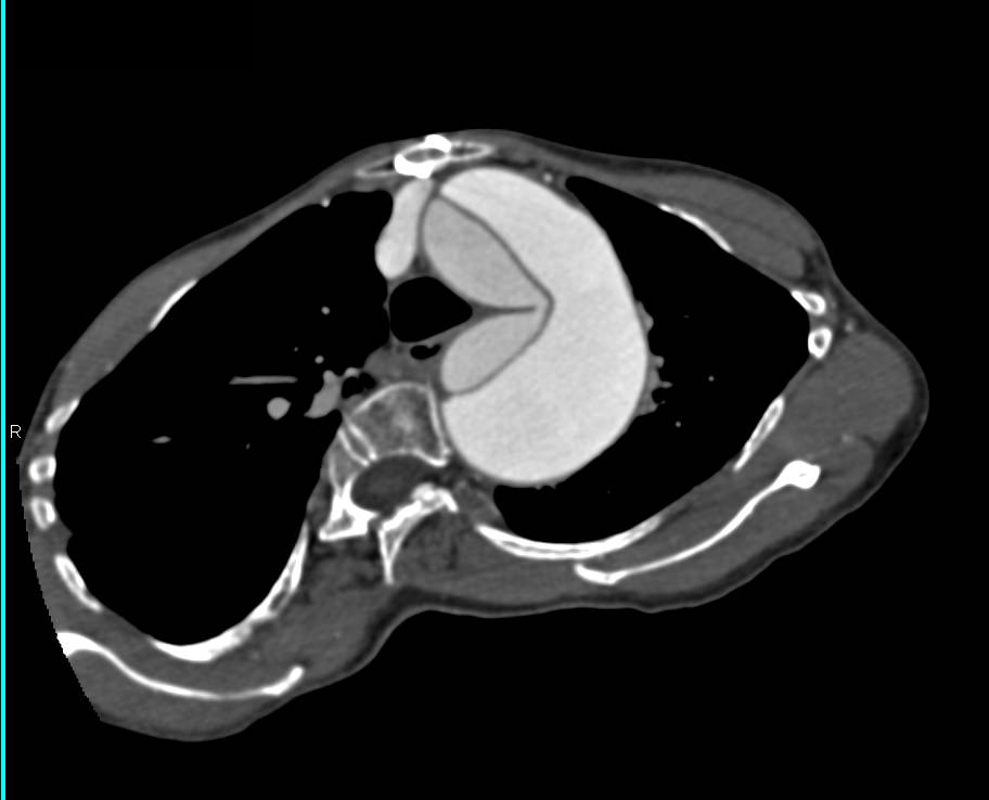 Incidental Renal Cell Carcinoma in Patient for Evaluation of an Aortic Dissection - CTisus CT Scan