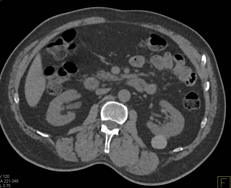 High Density Renal Cyst Left Kidney in Multiple Phases - CTisus CT Scan