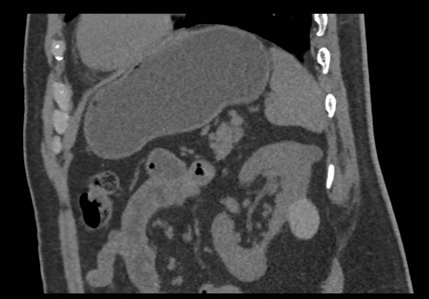 High Density Renal Cyst - CTisus CT Scan