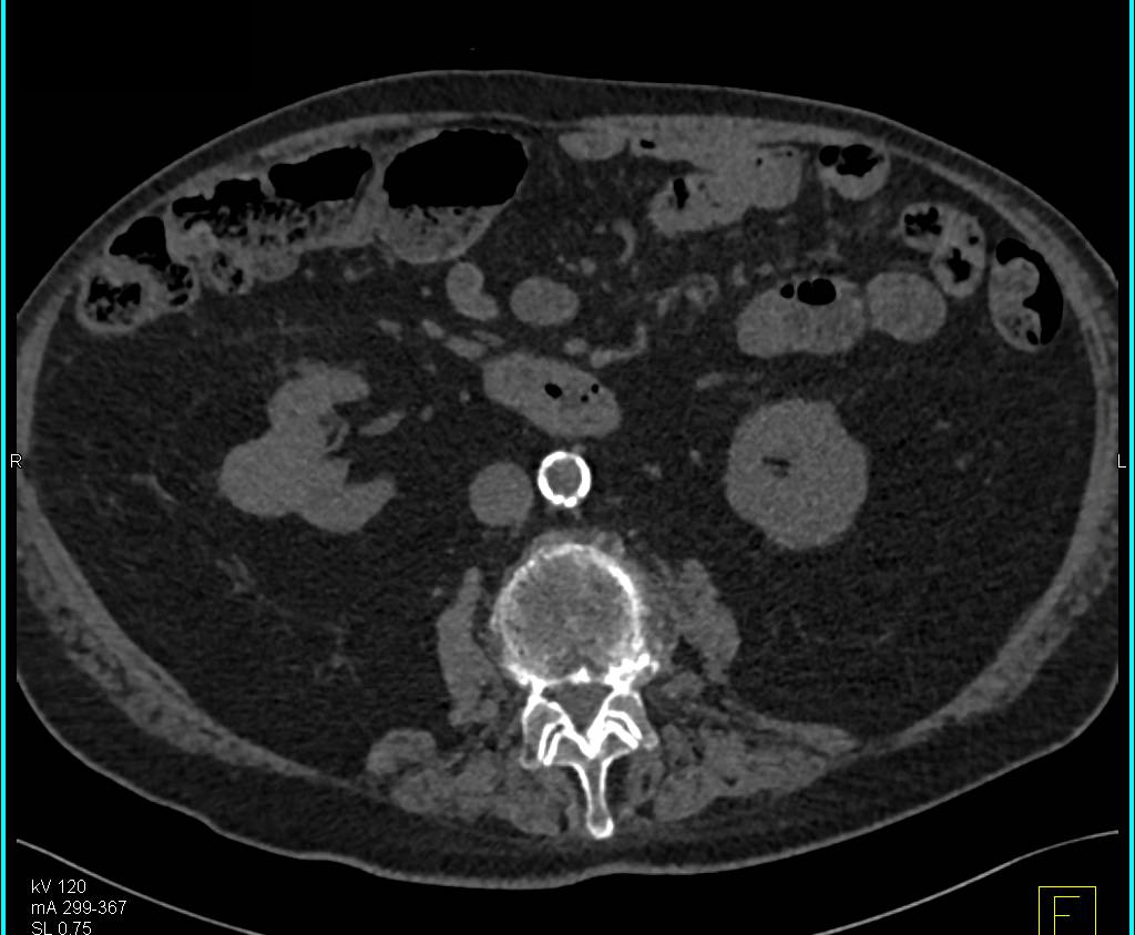 Papillary Renal Cell Carcinoma Right Kidney with Minimal Enhancement - CTisus CT Scan