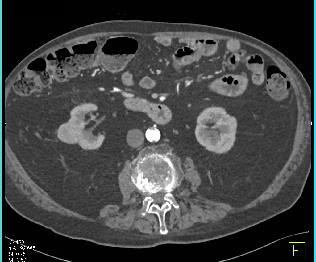 Papillary Renal Cell Carcinoma Right Kidney with Minimal Enhancement - CTisus CT Scan