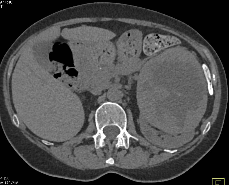 Renal Cell Carcinoma Looks a bit Like an Oncocytoma - CTisus CT Scan