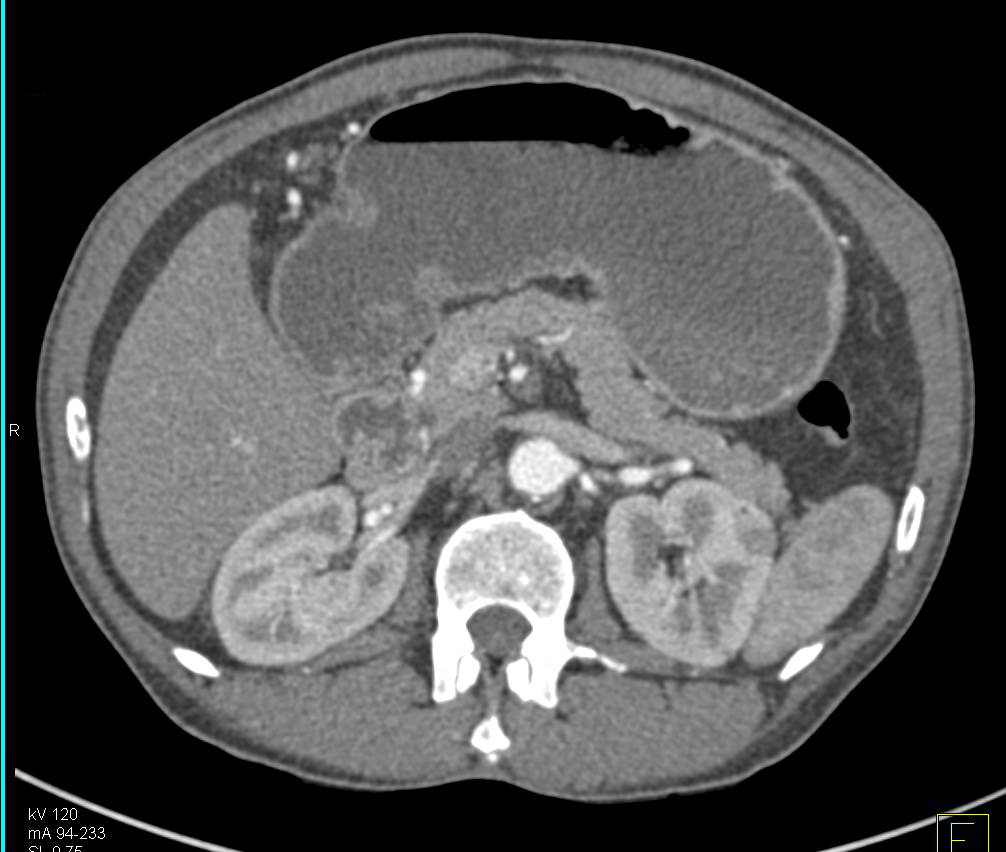 1cm High Density Renal Cyst Left Kidney - CTisus CT Scan