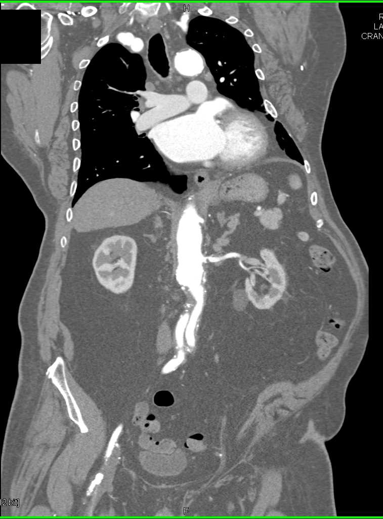 Critical Stenosis of the Left Renal Artery - CTisus CT Scan