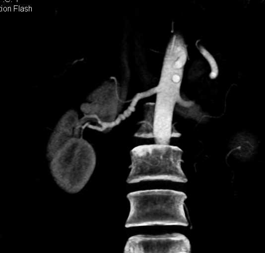 Fibromuscular Dysplasia of the Right Renal Artery - CTisus CT Scan