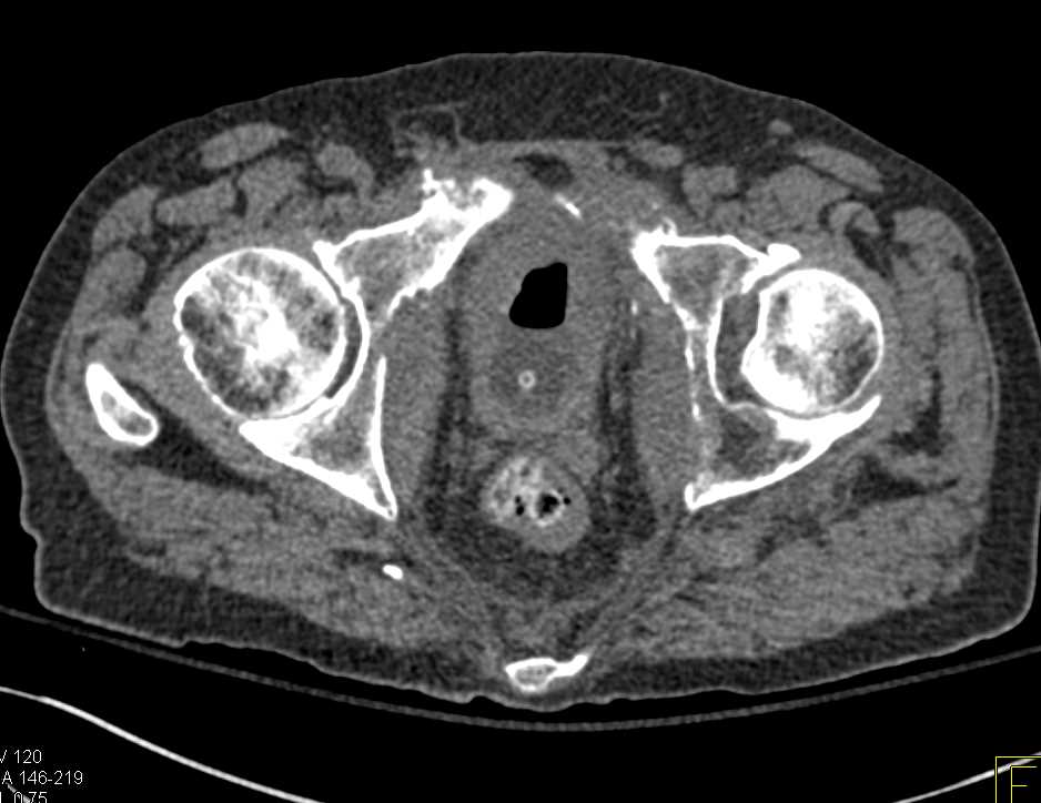 Bony Resorption due to Renal Osteodystrophy - CTisus CT Scan