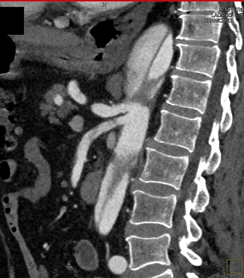 Delayed Perfusion of Right Kidney due to Renal Artery Arising off False Lumen - CTisus CT Scan