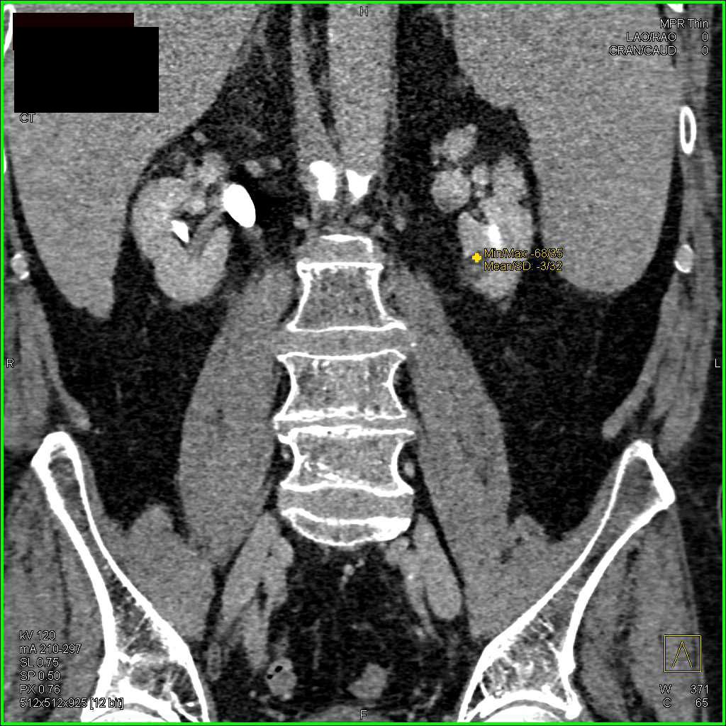 Scarred Kidneys due to Chronic Pyelonephritis - CTisus CT Scan