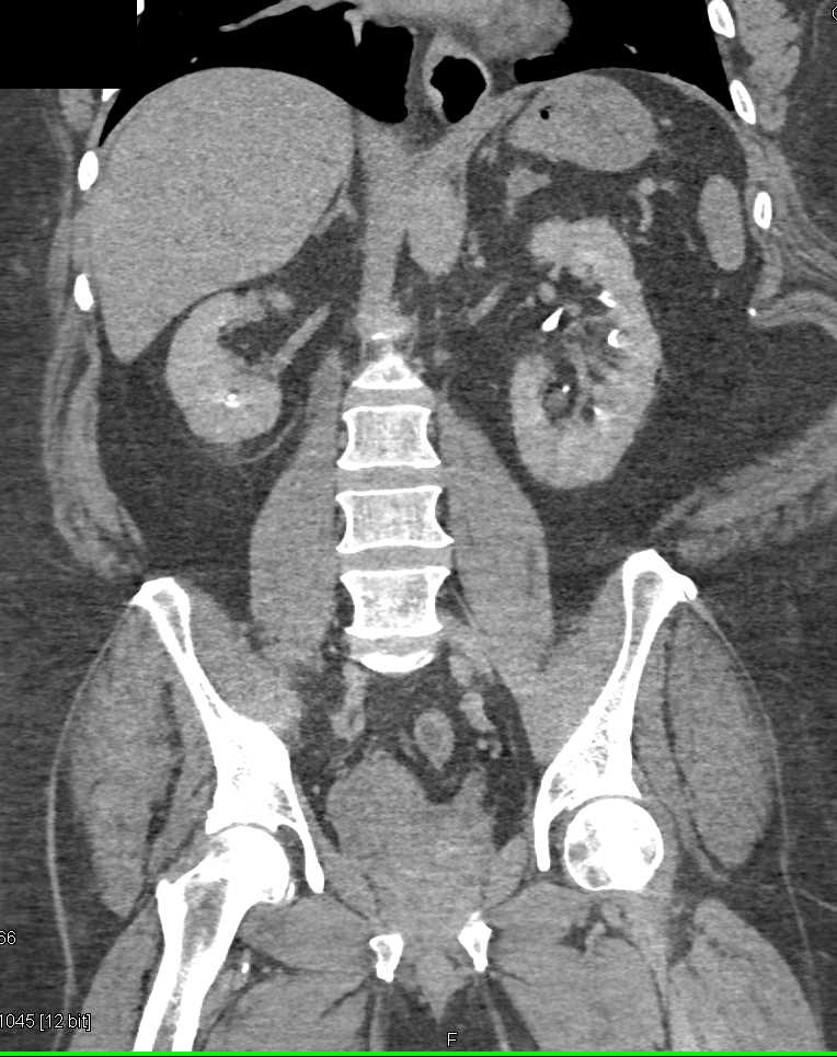 Carcinoma Arises in a Renal Transplant - CTisus CT Scan