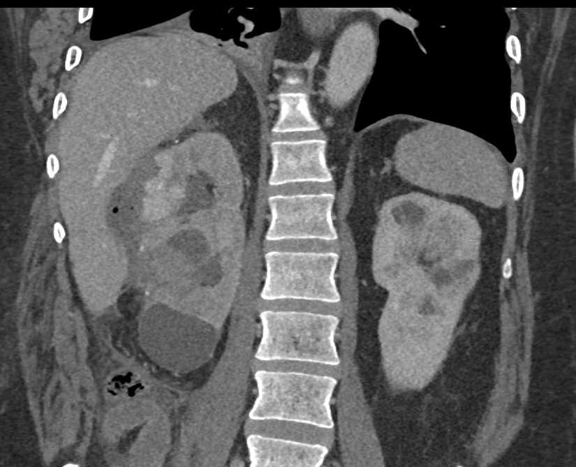 Active Bleed from Upper Pole Right Kidney - CTisus CT Scan