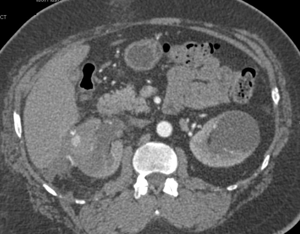 Obstructed Right Kidney with Contrast Extravasation - CTisus CT Scan