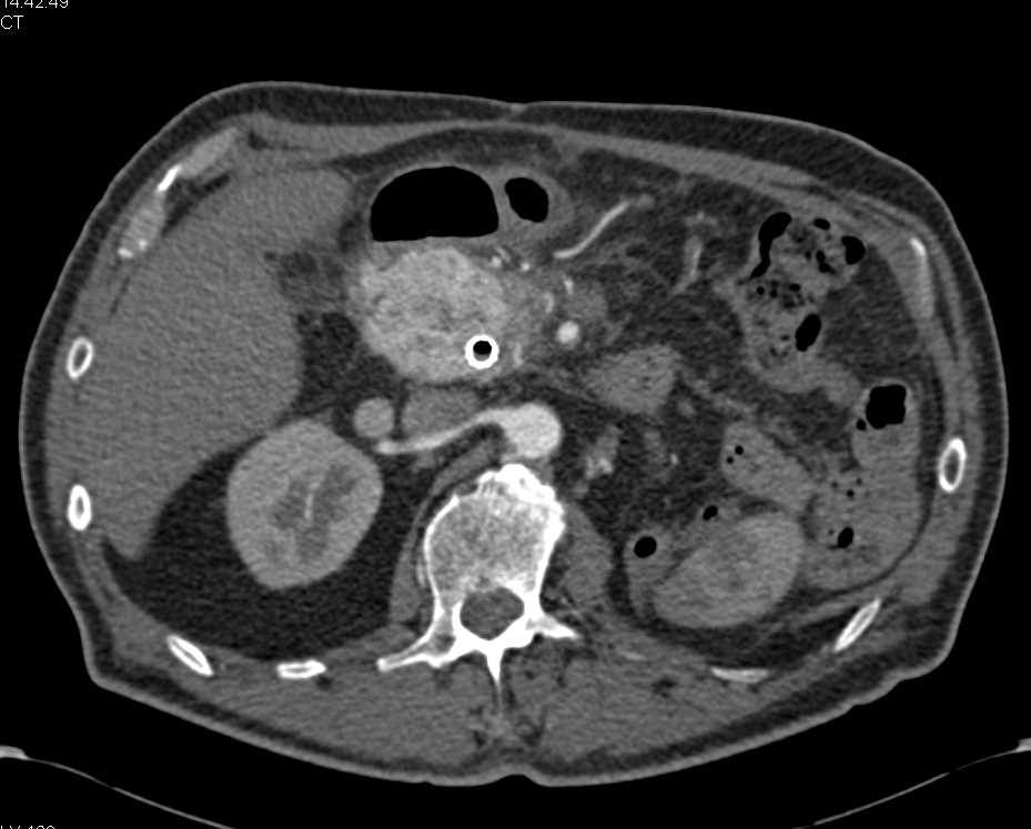 Recurrent Renal Cell Carcinoma Involves the Head of the Pancreas and the Right Adrenal Gland - CTisus CT Scan