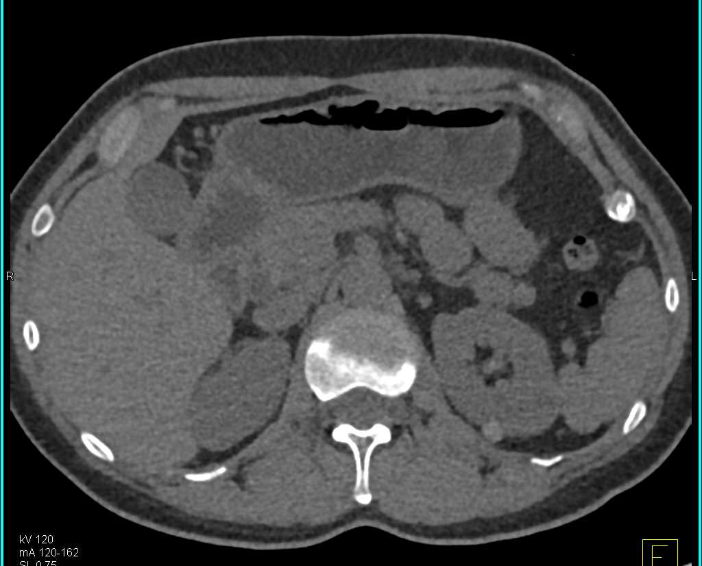 1cm High Density Cyst Left Kidney on Multiple Phases - CTisus CT Scan