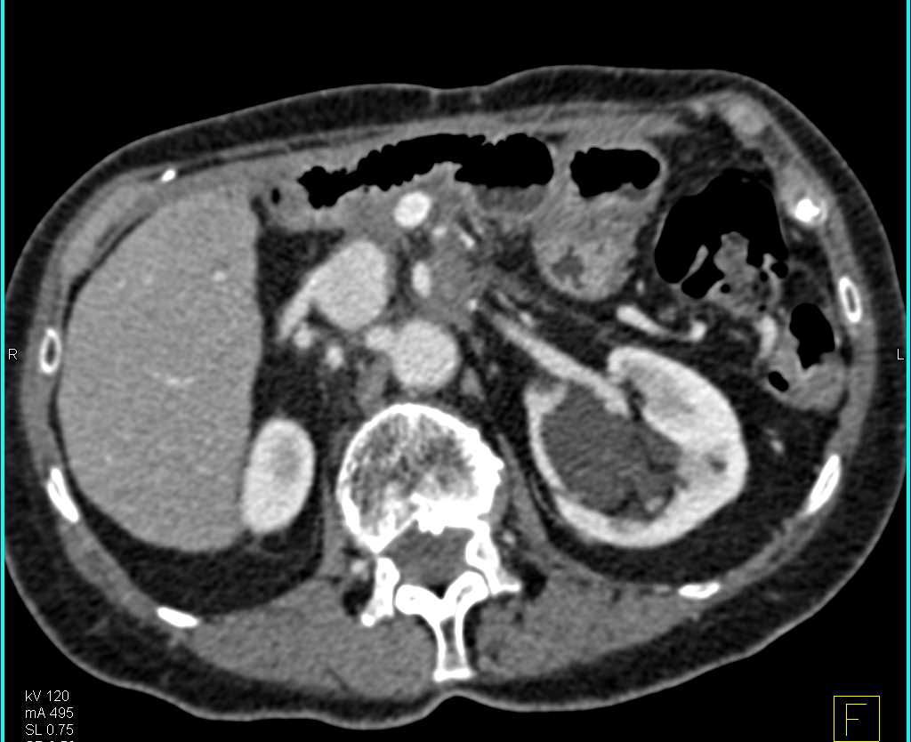 Parapelvic Cysts Left Kidney - Kidney Case Studies - CTisus CT Scanning