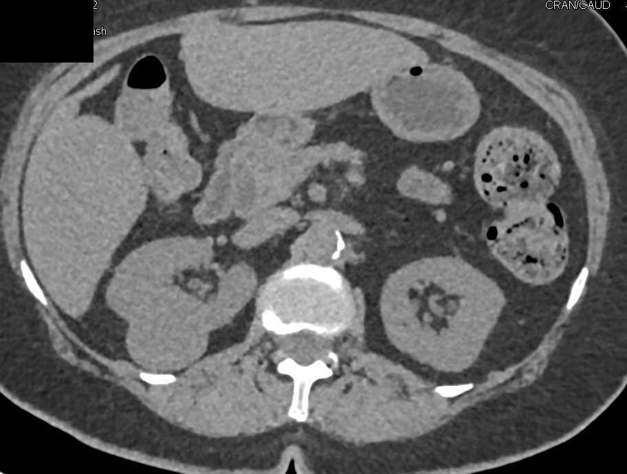 Chromophobe Renal Cell Carcinoma - CTisus CT Scan