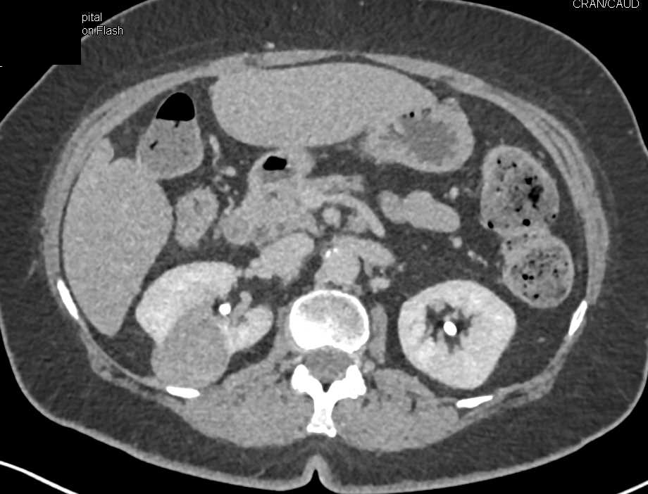 Chromophobe Renal Cell Carcinoma - CTisus CT Scan