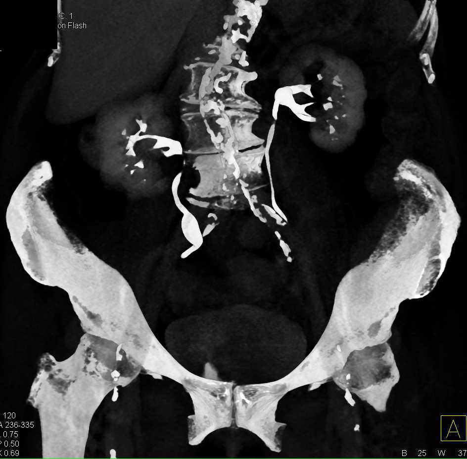 Clear Cell Renal Cell Carcinoma Right Kidney - CTisus CT Scan