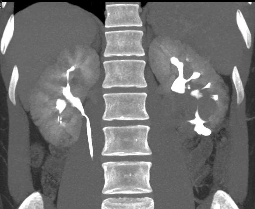 von Hippel Lindau Disease and Multiple Renal Angiomyolipomas - CTisus CT Scan