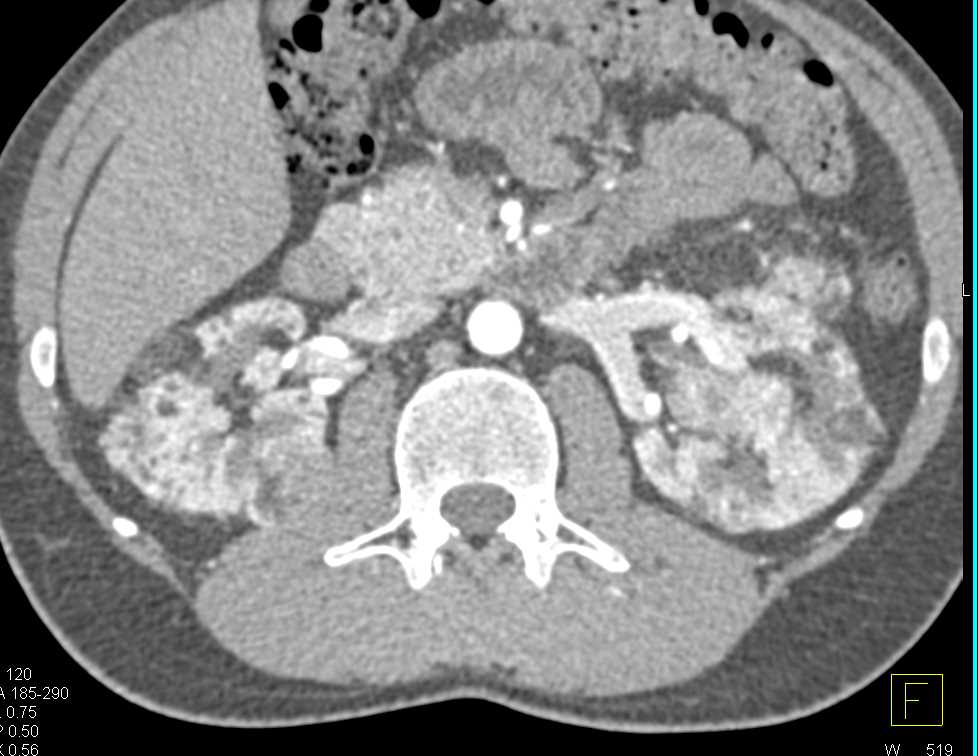 von Hippel Lindau Disease and Multiple Renal Angiomyolipomas - CTisus CT Scan