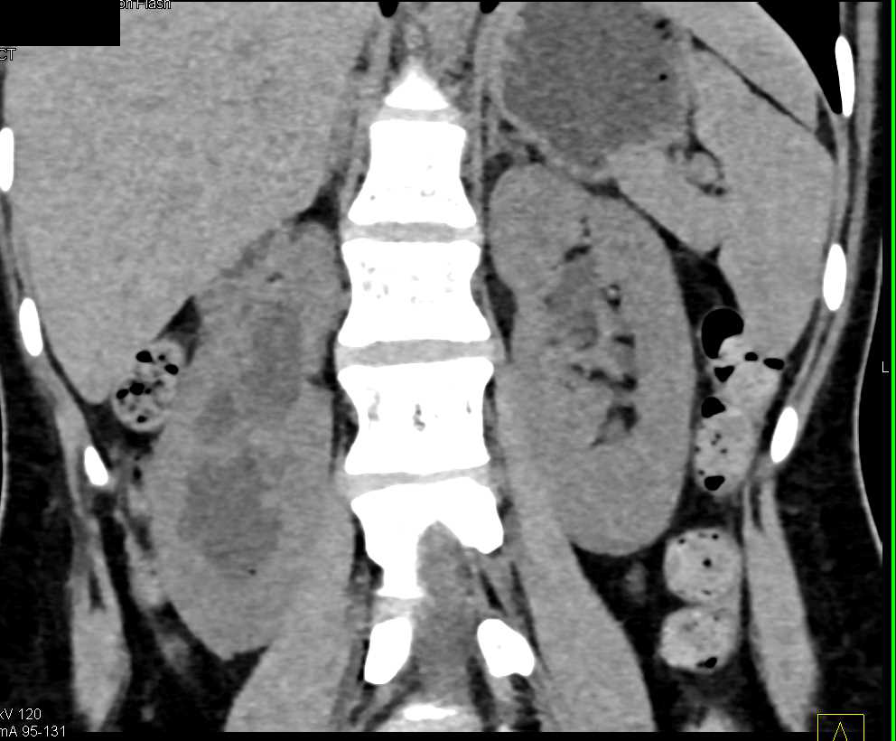 3D of Dilated Renal Pelvises with Blunted Calyces - CTisus CT Scan