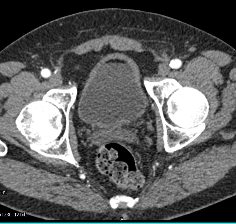 Fat-Fluid Level in the Bladder Following Partial Resection of a Renal Mass - CTisus CT Scan