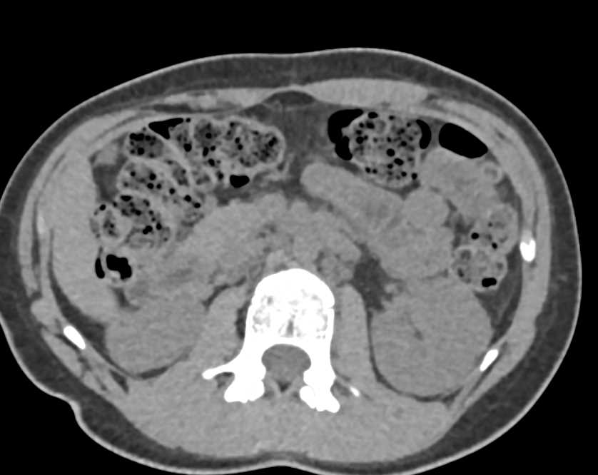 Chronic Pyelonephritis Right Kidney with Blunted Collecting System - CTisus CT Scan