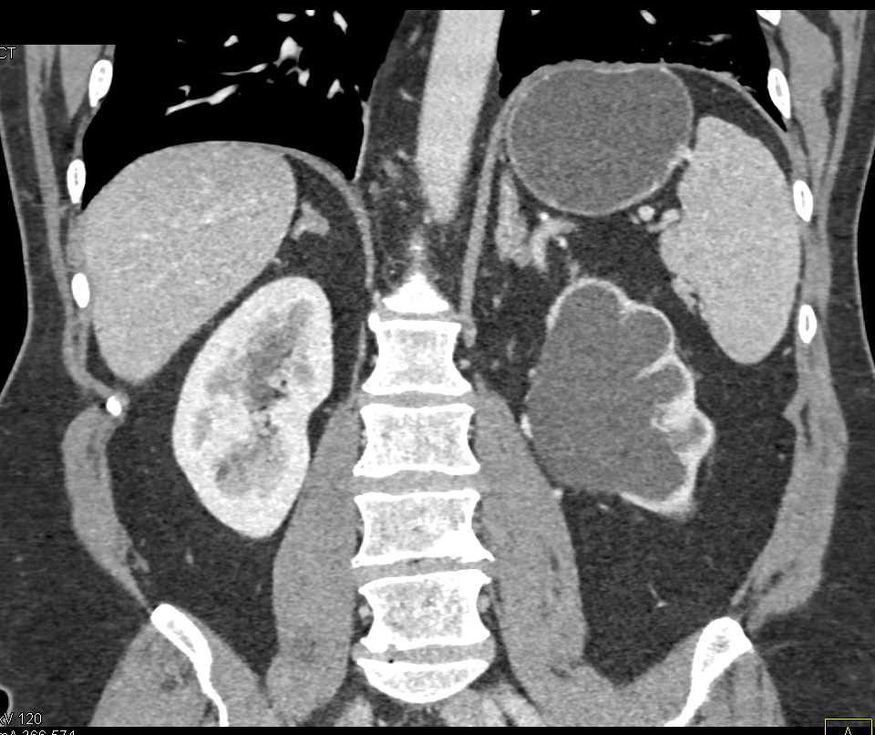 Left Ureteropelvic Junction (UPJ) Obstruction with Thinning of Cortex Left Kidney - CTisus CT Scan