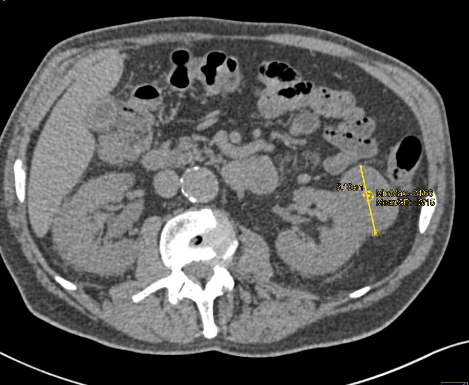 High Density Left Renal Cyst Simulates a Renal Carcinoma - CTisus CT Scan
