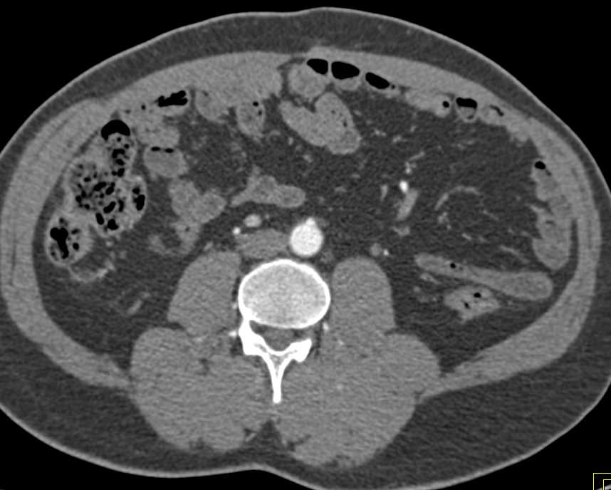 Recurrent Renal Cell Carcinoma Metastatic to the Contralateral Kidney and Adrenal - CTisus CT Scan