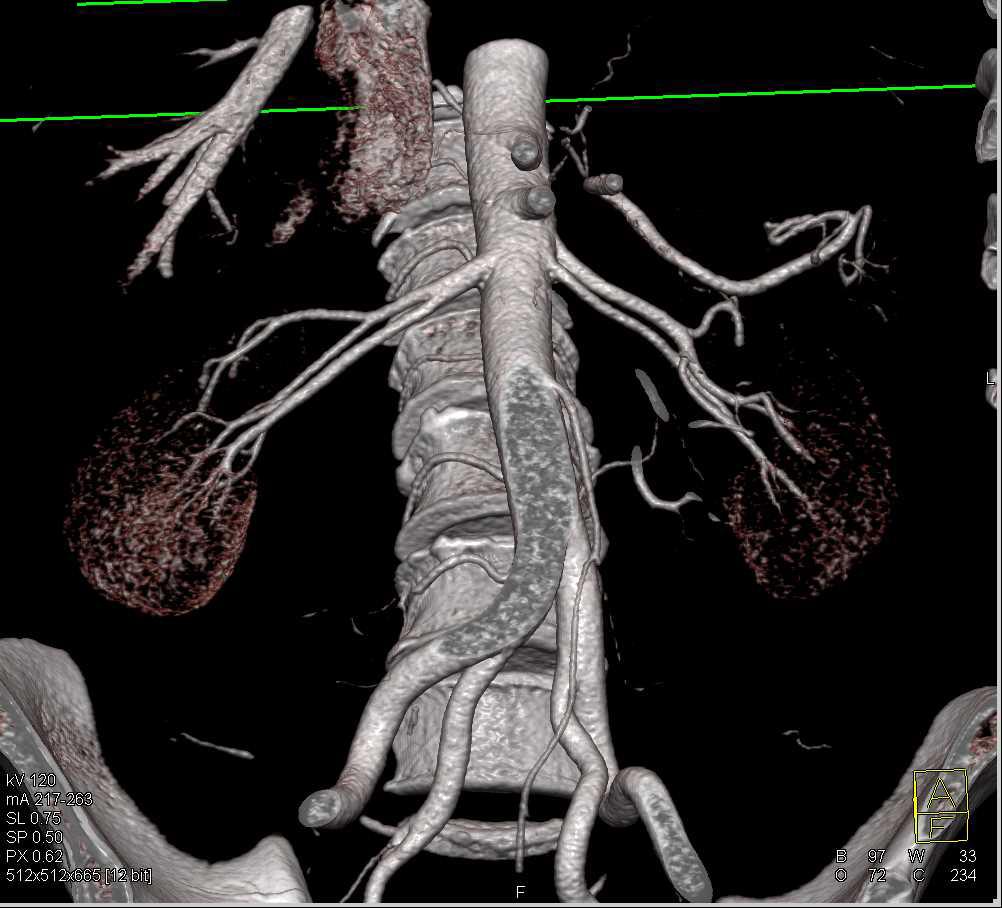 Two Left Renal Arteries and Prehilar Branching of the Right Renal Artery - CTisus CT Scan