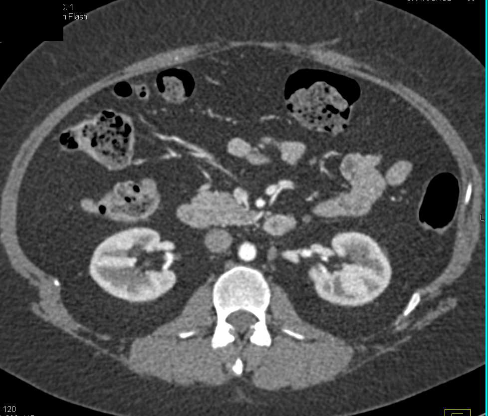 Subtle Transitional Cell Carcinoma of Left Ureter - CTisus CT Scan
