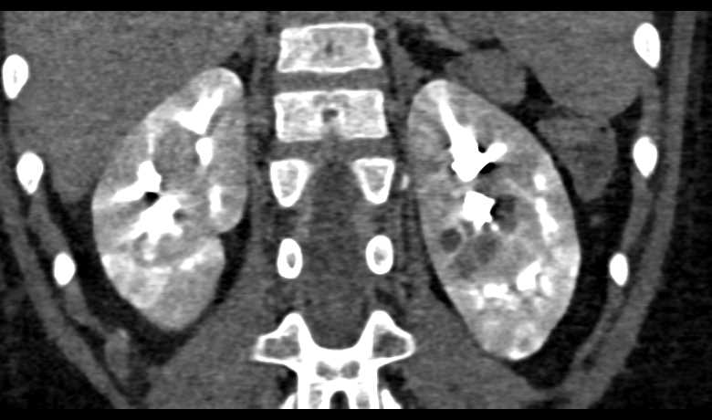 Bosniak 2F Cyst - CTisus CT Scan