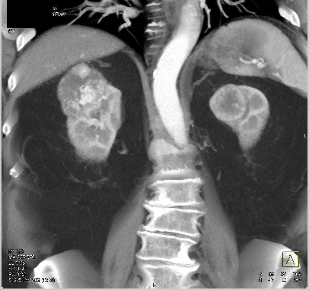 Bilateral Renal Cell Carcinomas - CTisus CT Scan