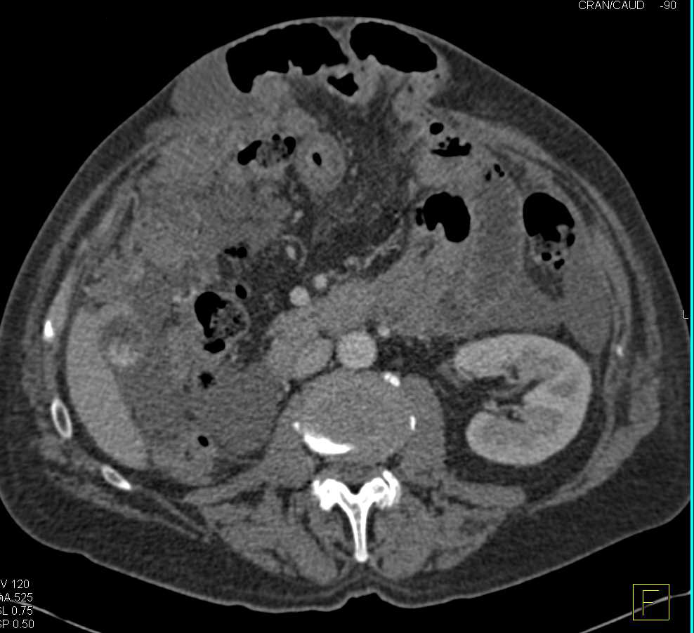 Carcinomatosis due to Renal Cell Carcinoma - CTisus CT Scan