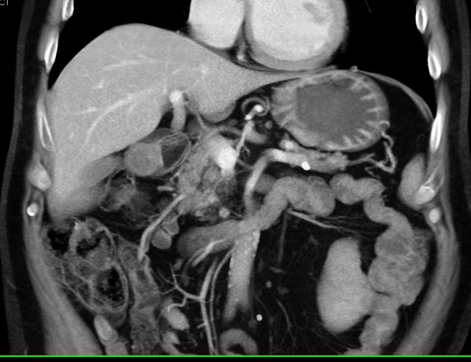 Vascular Metastases to the Spleen in a Patient with Renal Cell Carcinoma - CTisus CT Scan